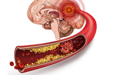 75% người đột quỵ tại Việt Nam liên quan đến thừa Cholesterol. Chắc chắn ai cũng ngạc nhiên điều này