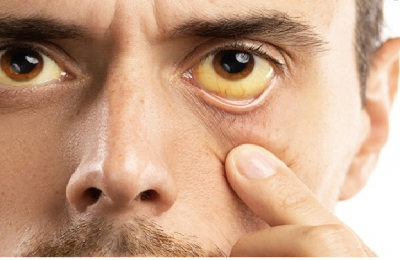 10 Dấu hiệu cảnh báo bạn bị nhiễm sán dây không nên bỏ qua